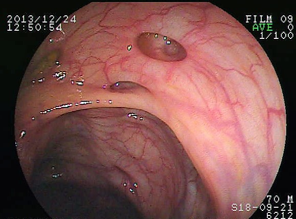 Image showing diverticuli (holes) in the walls of the colon