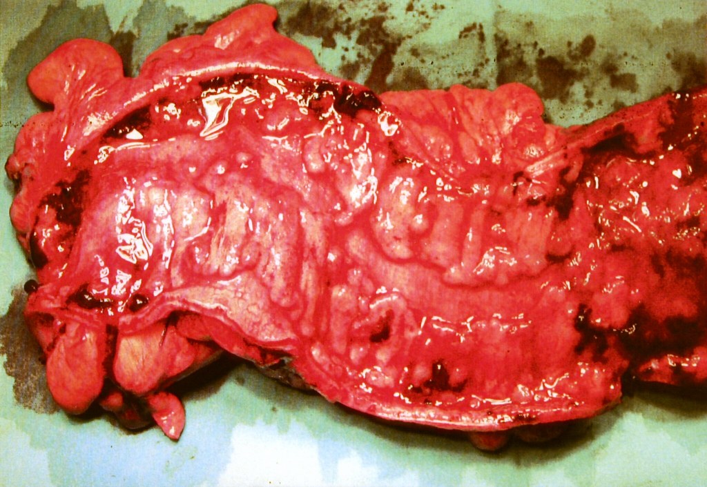 Photo of an intestine with inflamed walls covered in sores. It is bright red in color.