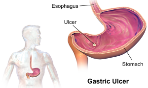 Gastric ulcers are sores that form in the walls of the stomach