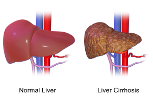 picture of a healthy liver that is smooth and dark red, and liver with cirrhosis that is stiff, hard, and brown.