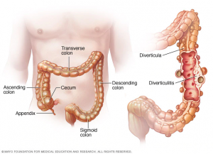 Diagram showing the large intestine with diverticula (holes leading to pouches) in the walls. The pouches trap waste and, if they become infected, inflammation occurs and a person suffers from painful diverticulitis.