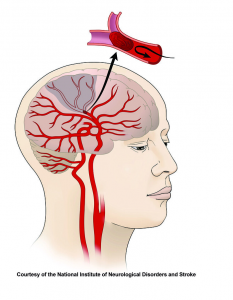 Strokes can be caused by blood clots in the brain that limit or completely stop blood flow to an area.