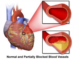 Arteries that feed the heart can be blocked with plaque, reducing blood flow to parts of the heart muscle.