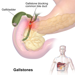 Depiction of the gallbladder, duodenum, and pancreas. The common bile duct brings secretions from both the pancreas and gallbladder into the duodenum. Gallstones can block the duct, causing pain.