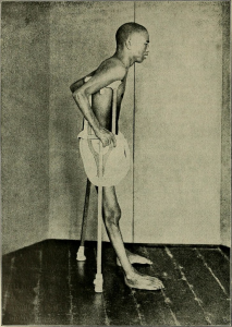 Photo showing a man with muscle wasting due to thiamin deficiency