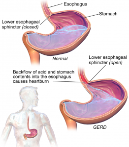 In gastroesphageal reflux disease or GERD, there is a back flow of acid and stomach contents into the esophagus through the lower esophageal sphincter causing a burning sensation
