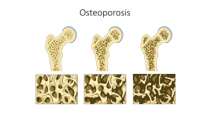Image of increasingly porous bone due to osteoporosis progression