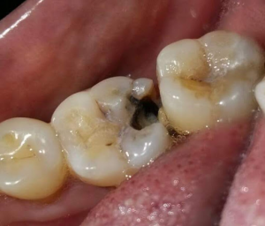 Photo showing a black spot on a molar which is a cavity.
