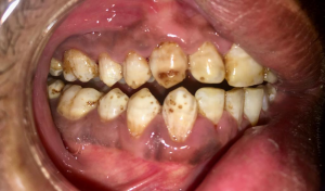 Photo of teeth with brown spots indicating excess fluoride