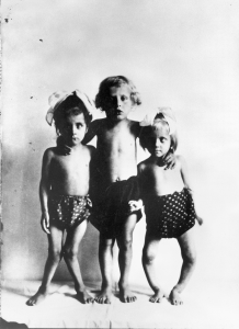 Photo showing three children with bowed legs or knees together - signs of rickets.