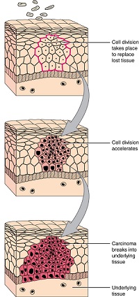 his series of three diagrams shows the development of cancer in epithelial cells. In all three diagrams, layers of epithelial tissue cover a generic underlying tissue. In the first diagram, an injury kills a section of the epithelial cells. In the second image, new epithelial cells have completely filled in the wounded area. However, cell division is still accelerating. In the lowest diagram, the epithelial cells have continued to divide and have now expanded beyond the original wound area. The group of dividing cells, now called a carcinoma, breaks into the layer of underlying tissue.