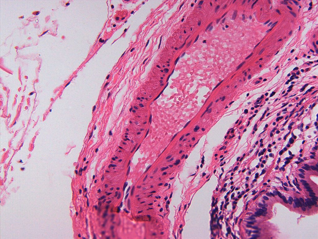 Simple squamous epithelium (endothelium) lining the lumen of a blood vessel. Red blood cells (erythrocytes) fill the lumen of the vessel.