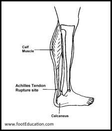 Achilles Tendon Rupture – Orthopaedia: Foot & Ankle