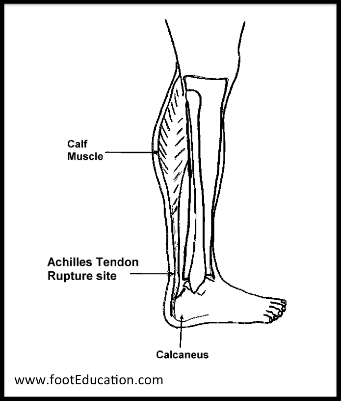 Achilles Tendon Rupture Orthopaedia Foot & Ankle