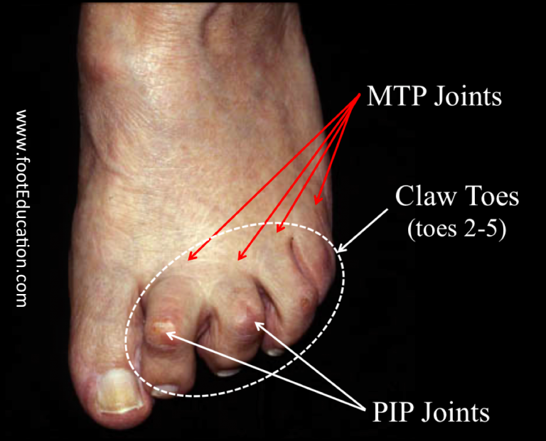 disorders-of-the-lesser-toes-orthopaedia-foot-ankle