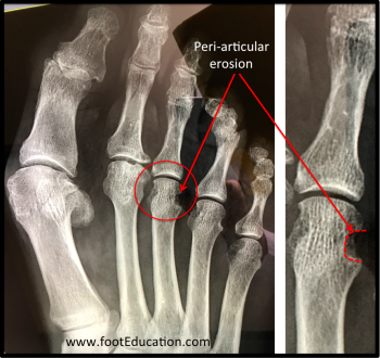 Rheumatoid Disorders of the Foot and Ankle – Orthopaedia: Foot & Ankle