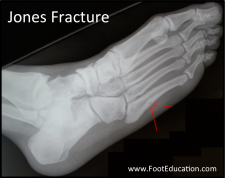 Stress Fractures of the Foot – Orthopaedia: Foot & Ankle