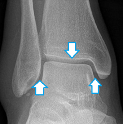 Голеностопный сустав рентген анатомия. Рентген таранной кости норма. Суставная щель голеностопного сустава. Голеностопный сустав рентген норма.