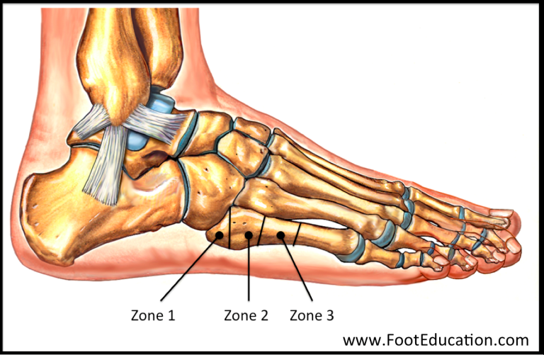 How To Heal A Fracture Of 5th Metatarsal