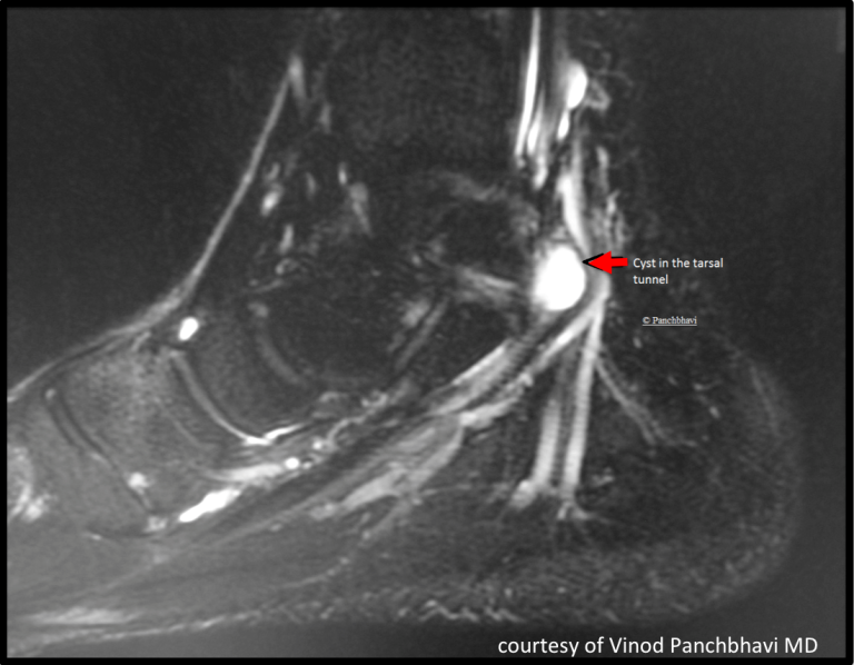 Tarsal Tunnel Syndrome Orthopaedia Foot And Ankle 0380