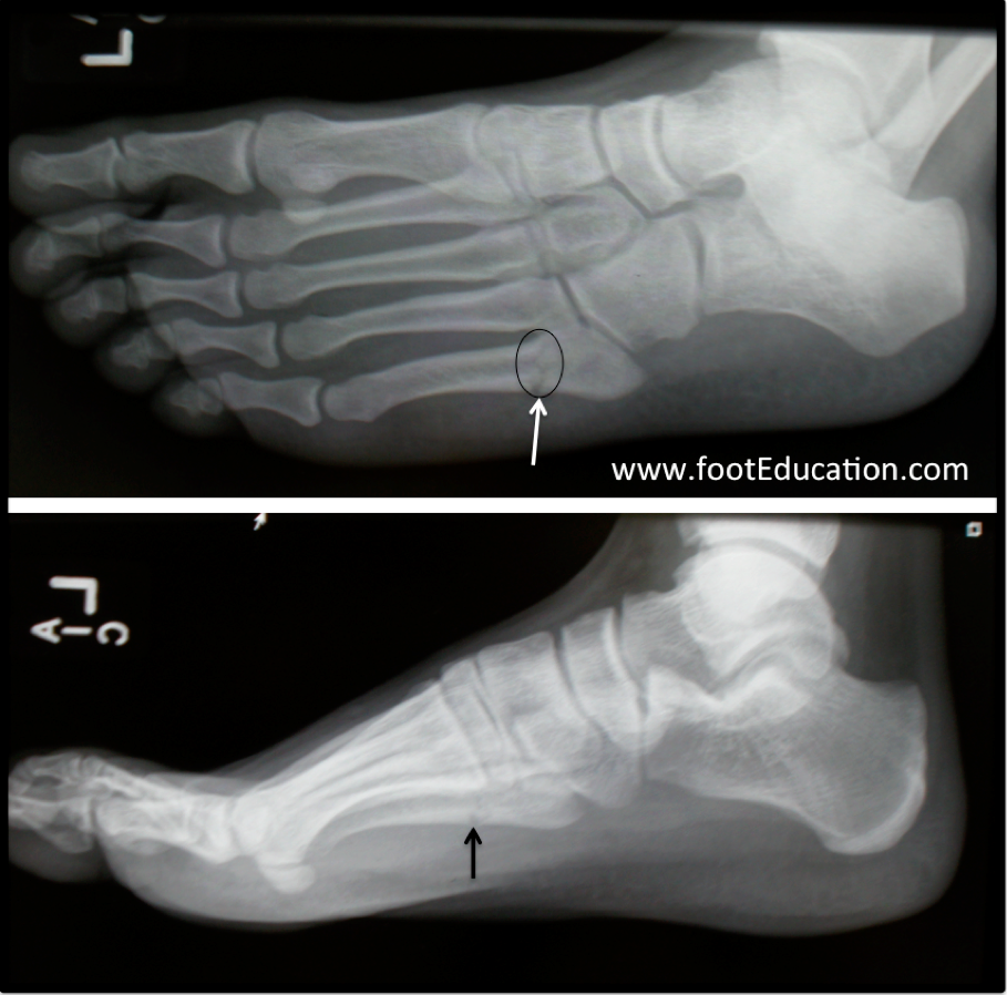 Metatarsal Fractures Orthopaedia Foot And Ankle