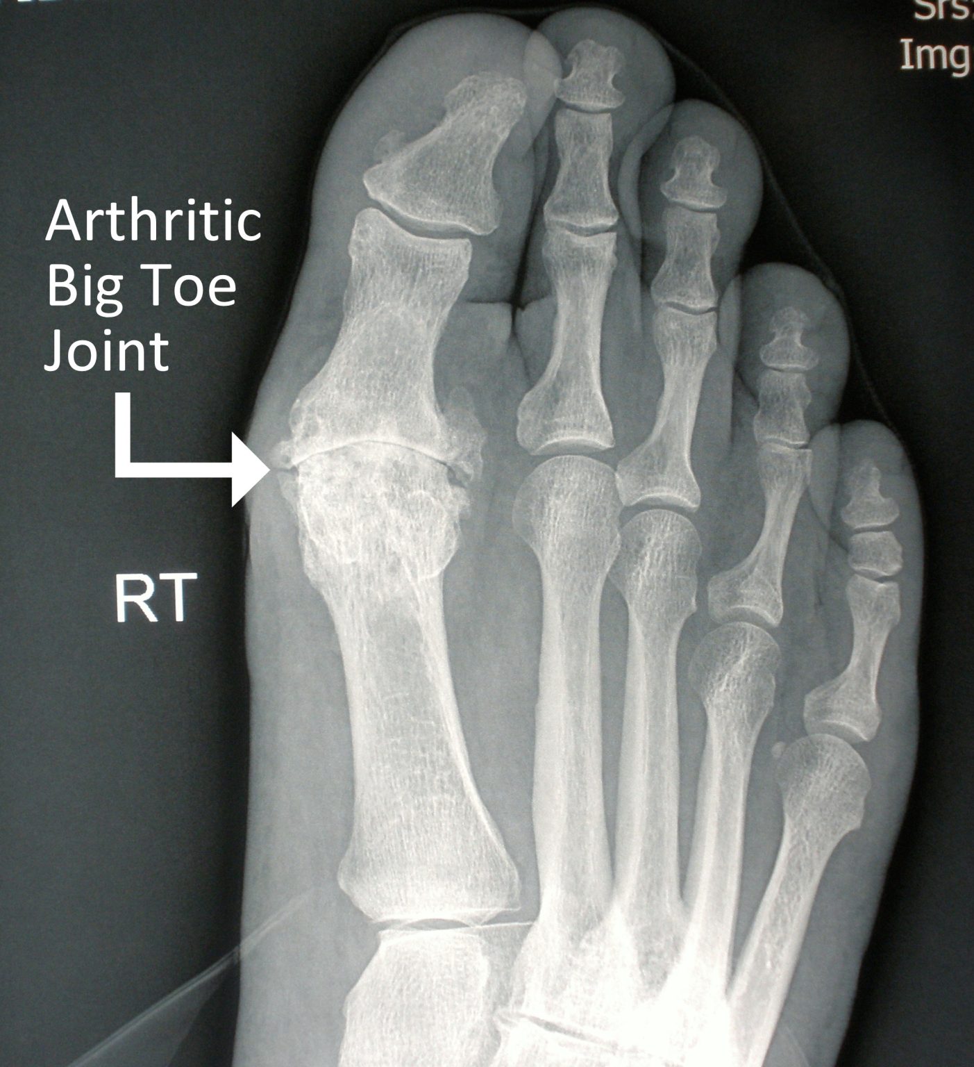 Disorders of the Great Toe – Orthopaedia: Foot & Ankle