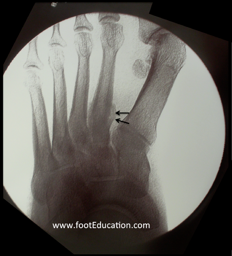 Metatarsal Fractures Orthopaedia Foot & Ankle