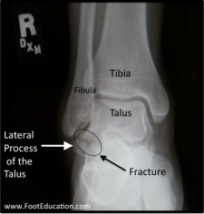 Hindfoot Fractures – Orthopaedia: Foot & Ankle