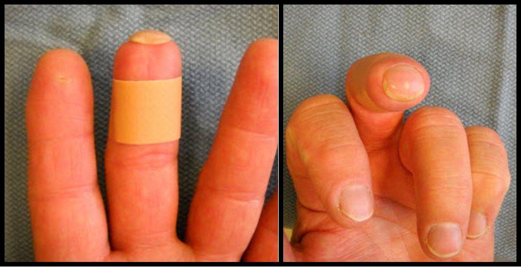 Disorders of the nail Orthopaedia Hand