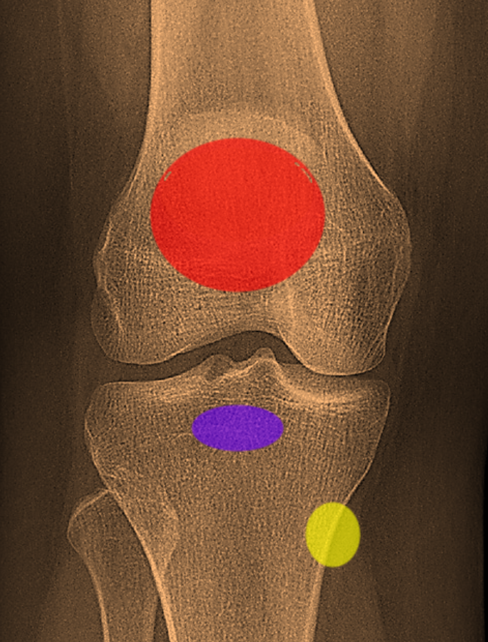 Bursitis Of The Knee Orthopaedia Sports Medicine 0436