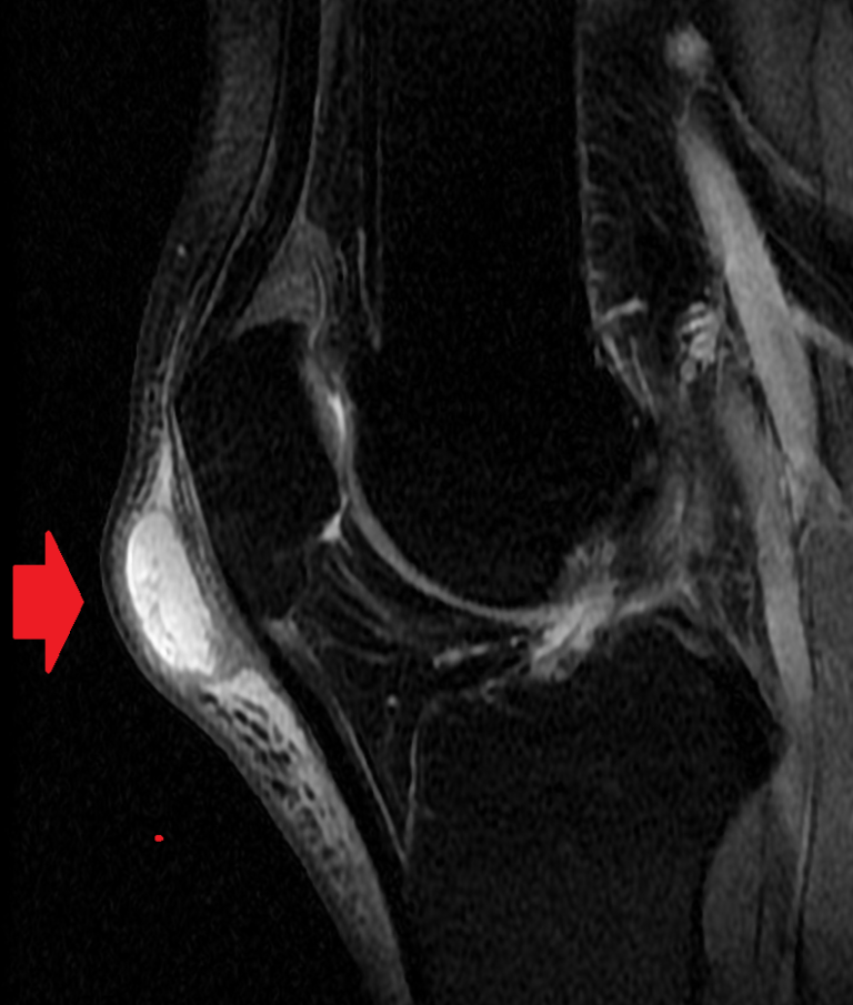 Bursitis Of The Knee Orthopaedia Sports Medicine