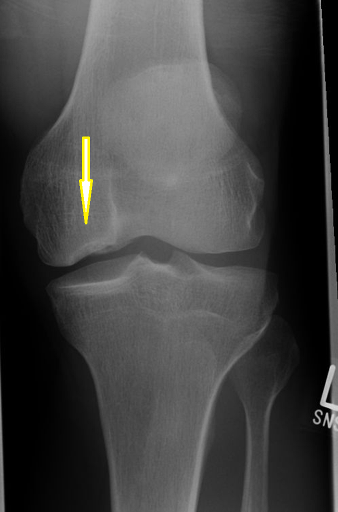 Chondral Injuries of the Knee – Orthopaedia: Sports Medicine