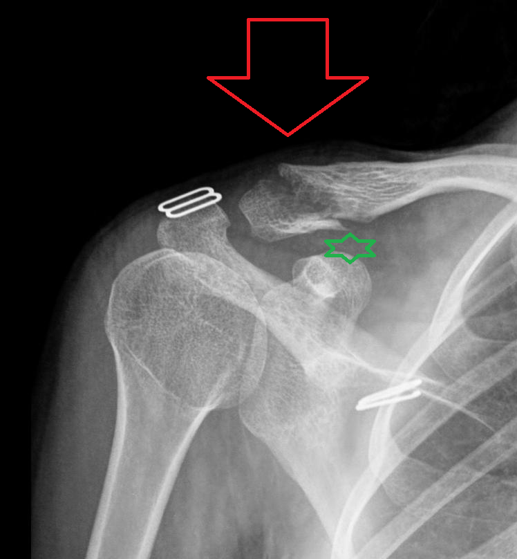 Clavicle Fractures Orthopaedia Sports Medicine
