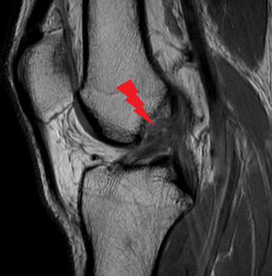 Cruciate Ligament Disorders – Orthopaedia: Sports Medicine