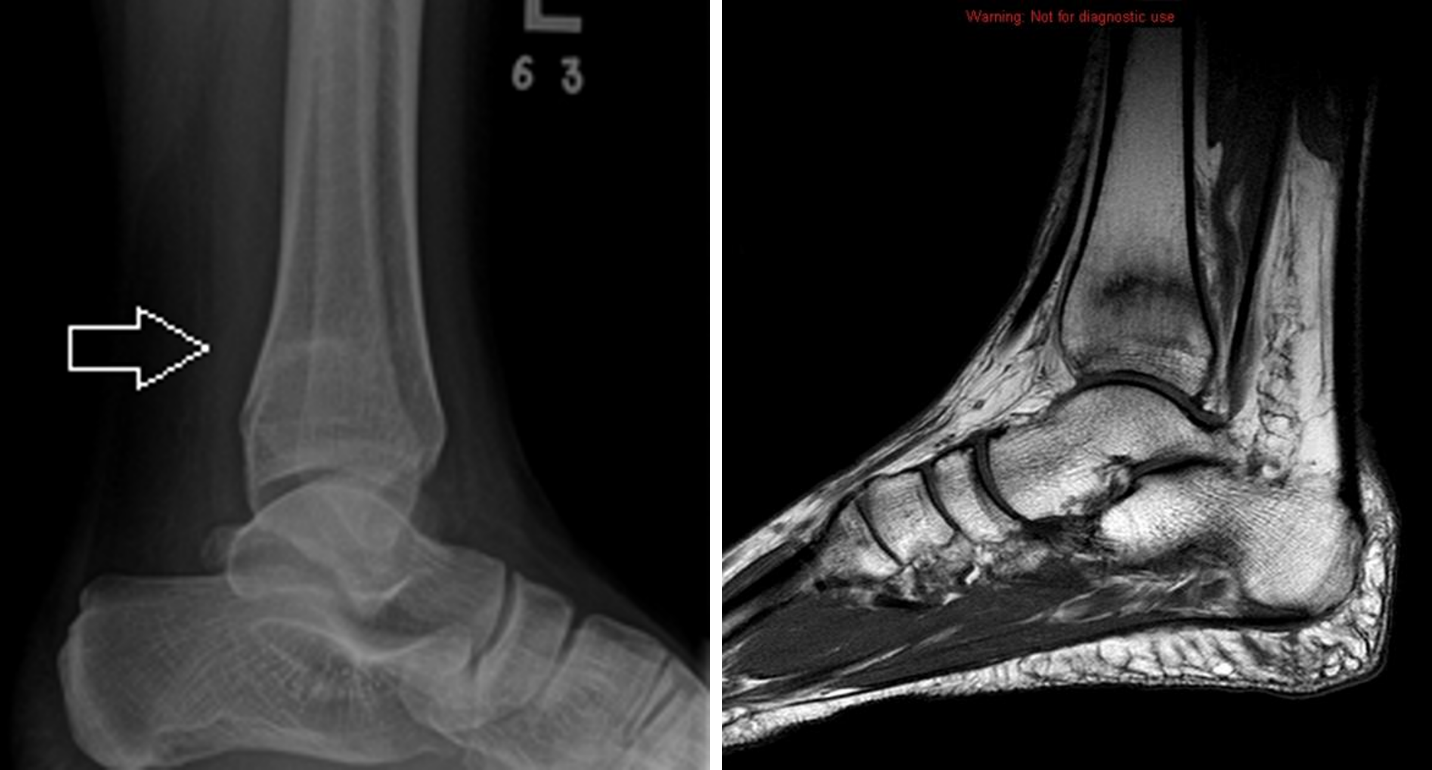 Stress Fractures and the Female Athletic Triad Orthopaedia Sports Medicine