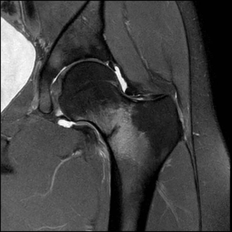 Stress Fractures and the Female Athletic Triad – Orthopaedia: Sports ...