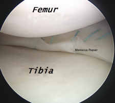 Meniscus Tears – Orthopaedia: Sports Medicine