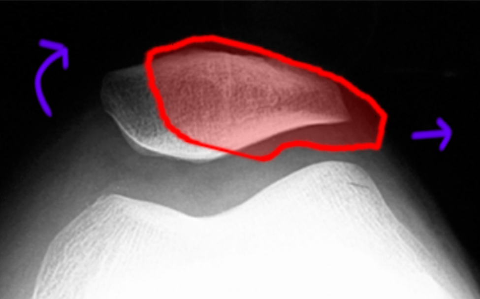 Patellofemoral Disorders Orthopaedia Sports Medicine