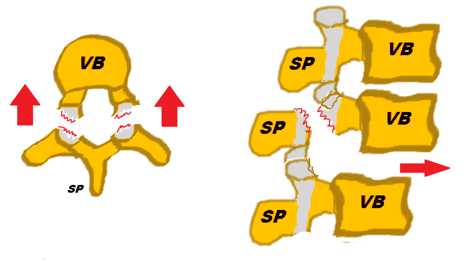 Spondylolysis and Spondylolisthesis Orthopaedia Sports Medicine