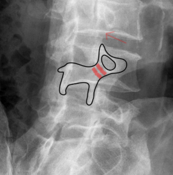 Spondylolysis and Spondylolisthesis – Orthopaedia: Sports Medicine